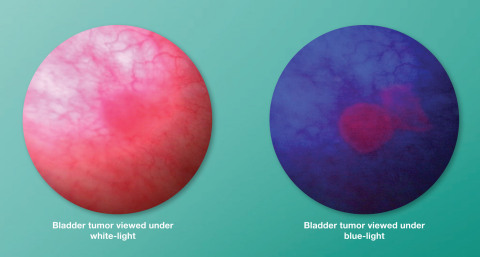 White light visualization is shown on the left. When viewed using Blue Light Cystoscopy with Cysview®, bladder tumor cells appear red or pink in contrast with the normal cells, which appear blue in color (shown on right). (Graphic: Business Wire)