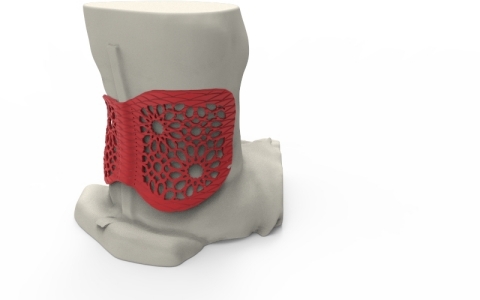 Using a 3D scan of Rožkova’s lower back, Baltic3D, a Stratasys Latvian reseller, designed and 3D pri ... 