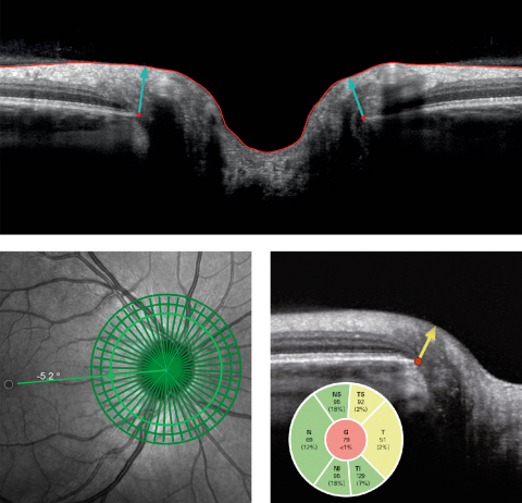 Analysis of the optic nerve head with Heidelberg Engineering’s SPECTRALIS® Glaucoma Module Premium Edition (Photo: Business Wire)