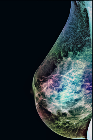 Mammogram sample analyzed by Zebra Medical Vision’s algorithm