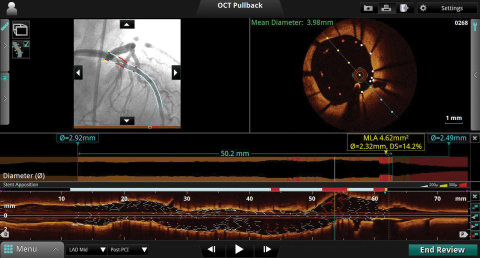St. Jude Medical™ Optical Coherence Tomography (OCT) Software features automated measurements, co-re ... 