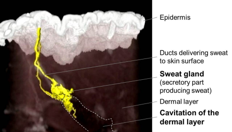 3-D image of the skin on X-ray CT. Sweat glands (yellow) are identified on the cavitation area (dotted). (Graphic: Business Wire)