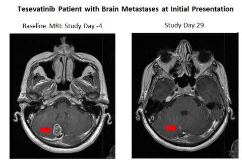 A patient with EGFR mutation-positive NSCLC with brain metastases and with no prior treatment (left) showed a partial response in the brain in an MRI taken after 29 days of tesevatinib therapy (right) and showed a partial response in both brain metastases and peripheral disease after 57 days of tesevatinib therapy (Photo: Business Wire)