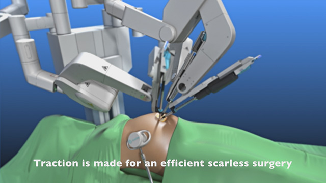 Demonstration of a magnetic scarless robotic cholecystectomy (gallbladder surgery) using the FDA-approved-Levita™ Magnetic Surgical System.
