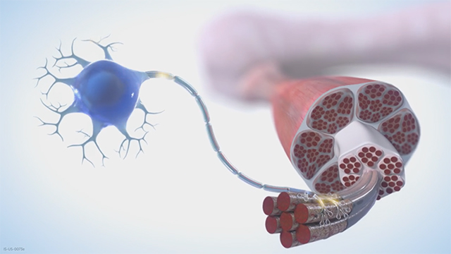 Video that provides an overview of the mechanism of disease (MOD) of spinal muscular atrophy (SMA) created for educational purposes only.