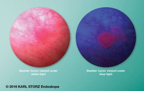 Blue Light Cystoscopy with Cysview provides a solution for enhanced detection and management of non-muscle invasive bladder cancer, as illustrated in this image. (Graphic: Business Wire)