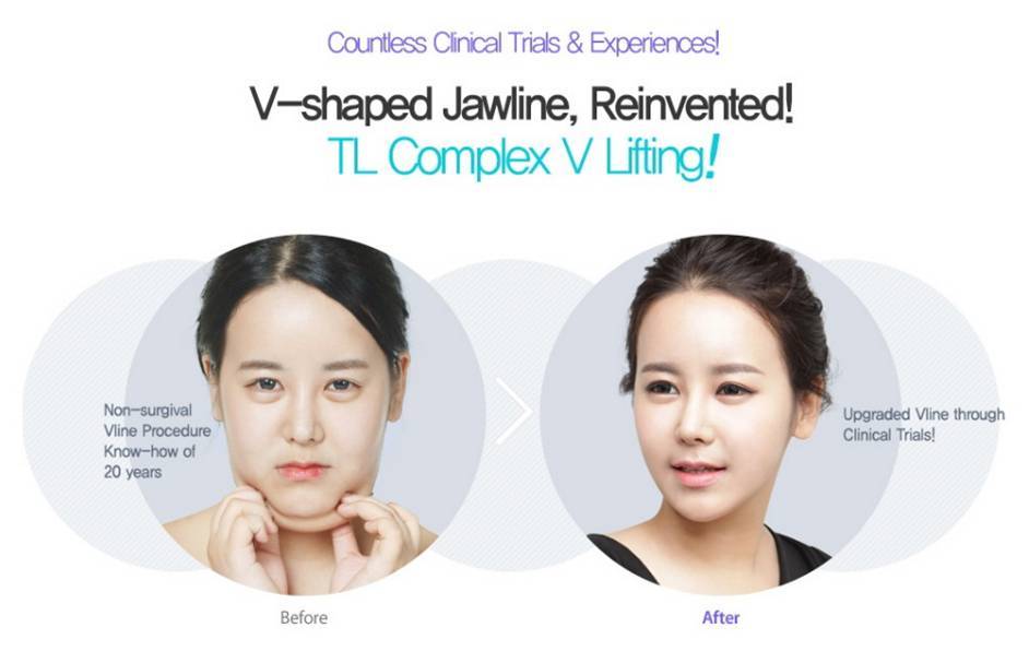 Dr Jung Yeon Ho's TL POWER V Lift Non Surgical Facial Contouring Gets the  Fantastic V Line Shaped Face without Bone Surgery!