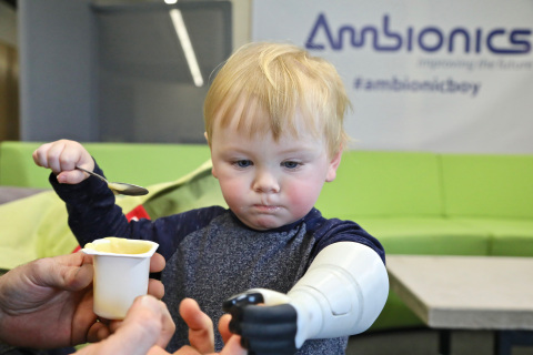 Two-year-old Sol with his fully-functioning Stratasys 3D printed hydraulic prosthetic arm, which enables him to move his thumb on his own (Photo: Business Wire)