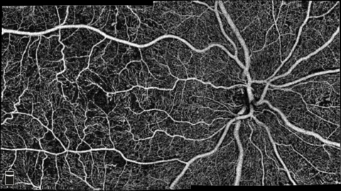 AngioVueHD Montage automatically combines two high-density images in a 10x6 mm field-of-view. Images courtesy of Adil El Maftouhi, O.D., Lyon, France