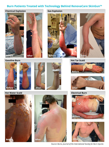 Six patients with severe second-degree burns treated with skin stem cell spray using technology behind the RenovaCare SkinGun™. (Photo: Business Wire)