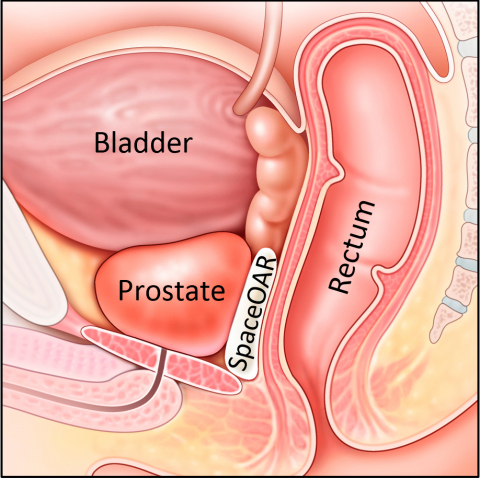 SpaceOAR® Hydrogel separates the prostate and rectum during radiation treatment, reducing rectal injury (Graphic: Business Wire)