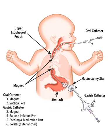Flourish device illustration in pediatric anatomy (Photo: Business Wire)