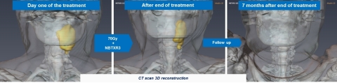 Illustration : 3D reconstruction of CT scan (tumor in yellow) patient treated at a 15% dose level showing a Complete Response 7 months after the end of the treatment. (Photo: Business Wire)