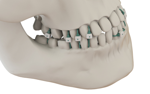 Minne Ties medical grade sutures securely hold the jaw in a closed position with less discomfort than metal wires to the patient and can be applied without the worry of wire stick risks to the surgeon. (Photo: Summit Medical, Inc.)