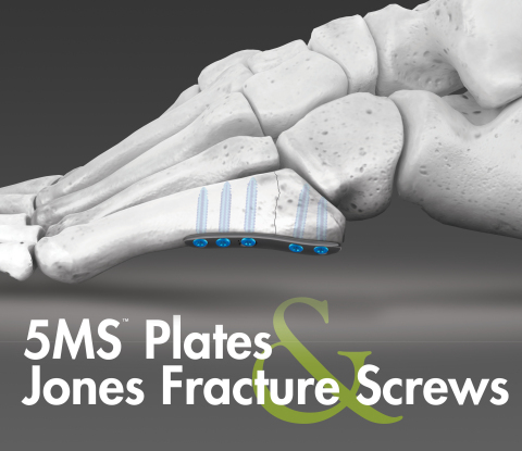 5MS Fracture Repair System (Graphic: Business Wire)