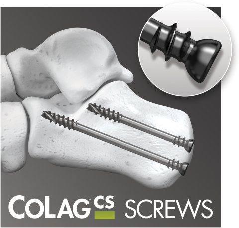 CoLag Locking Compression Screw System (Graphic: Business Wire)