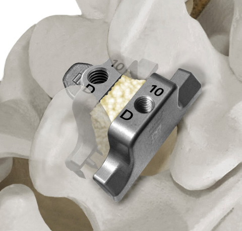 Dual Lamina StabiLink(R) implant (Photo: Business Wire)