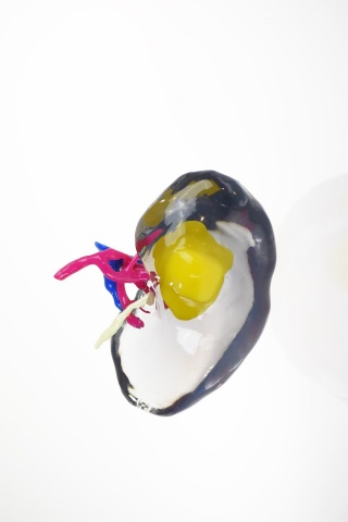 NYU School of Medicine leverages the Stratasys J750 to build multi-colored, 3D printed kidney cancer ... 