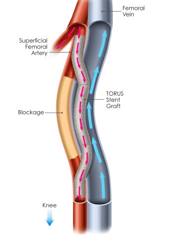 DETOUR Procedure - Percutaneous Femoropopliteal Bypass (Graphic: Business Wire)