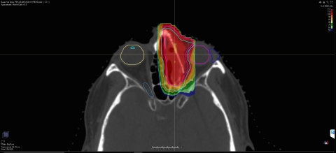 HYPERSCAN Pencil Beam Scanning technology provides sharp dose edges, providing clinicians a precise tool to deliver proton therapy to sensitive locations. (Photo: Business Wire)