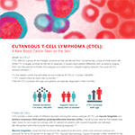 Die kutanen Lymphome gehören zu den Non-Hodgkin-Lymphomen und betreffen in erster Linie die Haut. Das CTCL ist der häufigste Typ des kutanen Lymphoms und geht typischerweise einher mit roten, schuppigen Flecken oder verdickten Hautplaques, die häufig dem Erscheinungsbild eines Ekzems oder einer chronischen Dermatitis sehr ähnlich sind. 