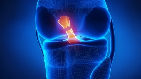 Figure 1 - An illustration depicting a ruptured ACL (Graphic: Business Wire)