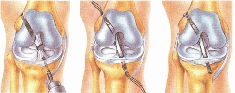 Figure 2 - Example of ACL reconstruction using CelGro(R) collagen rope (Graphic: Business Wire)