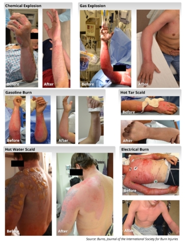 RenovaCare Highlights Burn Patients Sprayed with Stem Cells. (Photo: Business Wire) 