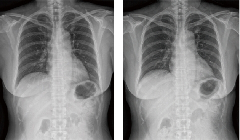 Chest PA comparison image, left 0.76 dGy.cm2 vs right 0.37 dGy.cm2. Can you notice the difference? 51% dose reduction while maintaining image quality.  (Photo: Business Wire)