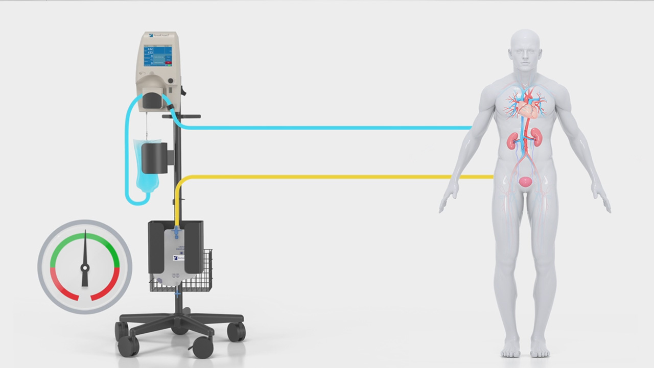 Watch how RenalGuard-Guided Diuretic Therapy is designed to manage fluids, thereby optimizing diuretic therapy for heart failure patients, and may relieve a number of symptoms related to heart failure.