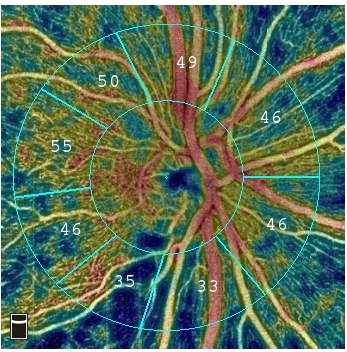 Vessel density of the optic disc displays loss of the retinal nerve fiber layer in a patient diagnosed with glaucoma. (Graphic: Business Wire)