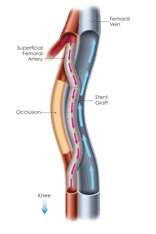 Completed femoropopliteal bypass performed by the DETOUR System from PQ Bypass. (Graphic: Business Wire)