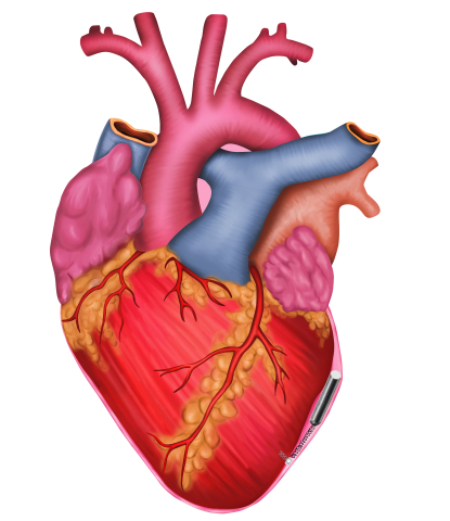 Model of the human heart with microprocessor located in the pericardial sac and attached to the left ventricle. (Graphic: Business Wire)