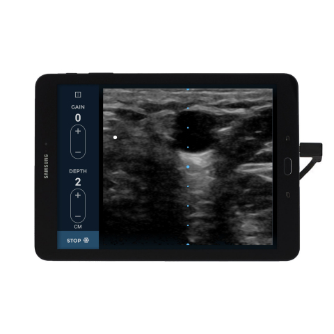 EchoNous Vein provides immediate, clear images at depths from 1 to 5 centimeters for quickly visualizing superficial and deeper veins with just two-button controls. (Photo: Business Wire)
