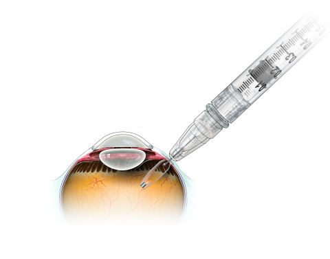 Genentech's Port Delivery System with ranibizumab (PDS) Implant in Eye with Refill Needle (Graphic: Business Wire)