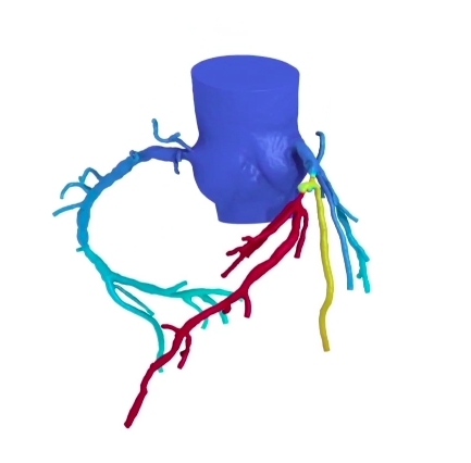 HeartFlow 3D Model (Graphic: Business Wire)