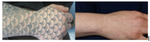 Tattoo removal: before and after (Photo: Business Wire)