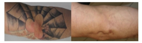 Tattoo removal: before and after (Photo: Business Wire)
