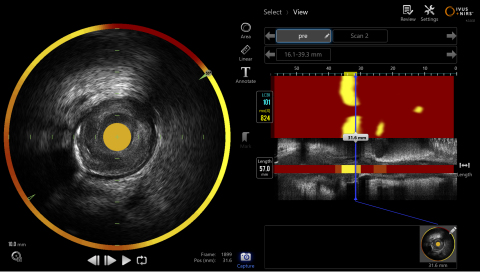 The Infraredx Makoto™ Intravascular Imaging System, utilizes a color-coded map, called a chemogram. The chemogram allows for the straightforward display of the presence of LCP in yellow and absence in red. The ability to detect LCP in order to stratify at-risk patients will enable cardiologists to make more personalized clinical decisions for their patients. (Photo: Business Wire).