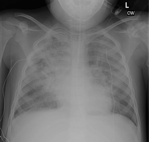 Chest x-ray of a child with Pediatric Acute Respiratory Distress Syndrome. The cloudy white area in the chest represents areas of lung which have been damaged and cannot function normally. As a result, the child has an endotracheal (breathing) tube which is connected to a mechanical ventilator. (Photo: Business Wire)