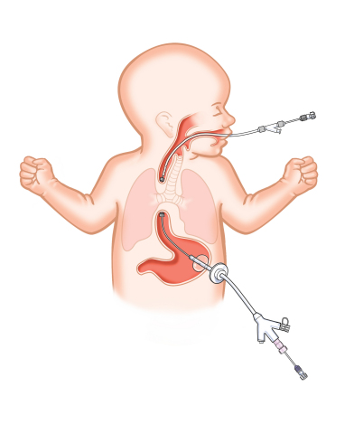 Flourish Pediatric Esophageal Atresia device (Graphic: Business Wire)