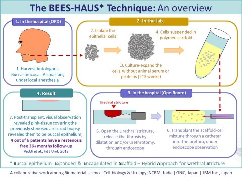 尿道狭窄に対する新しい治療方法：BEES-HAUSの手順と結果 （画像：ビジネスワイヤ）