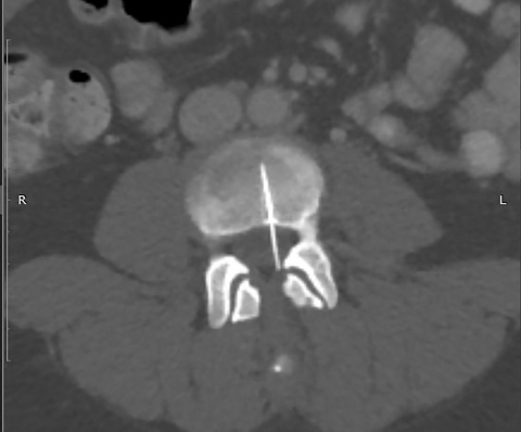 Axial view of 2017 CT scan shows needle through spinal canal into L4 vertebrae. (Photo: Cronin & Max ... 