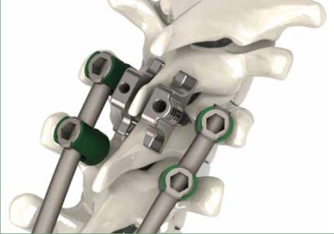 StabiLink Dual Lamina - Ultimate Thoracic Solution is the Perfect Adjunct to Pedicle Screw Fixation (Photo: Business Wire)