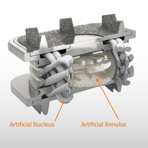 Illustration of the M6-C(TM) artificial cervical disc showing artificial visco-elastic nucleus and fiber annulus structures that mimics the anatomic design of a natural disc. (Photo: Business Wire)