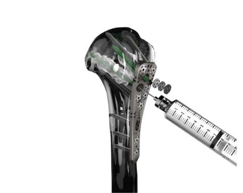 Proximal Hunerus Plating System with MDS Injection Screw. (Photo: Business Wire)