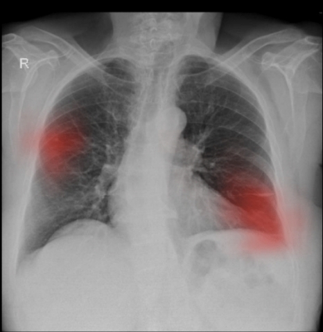The scan above is an example of a chest x-ray processed by Enlitic, highlighting the presence of a lung nodule in the mid zone of the right lung and a linear atelectasis in the left lung. (Photo: Business Wire)