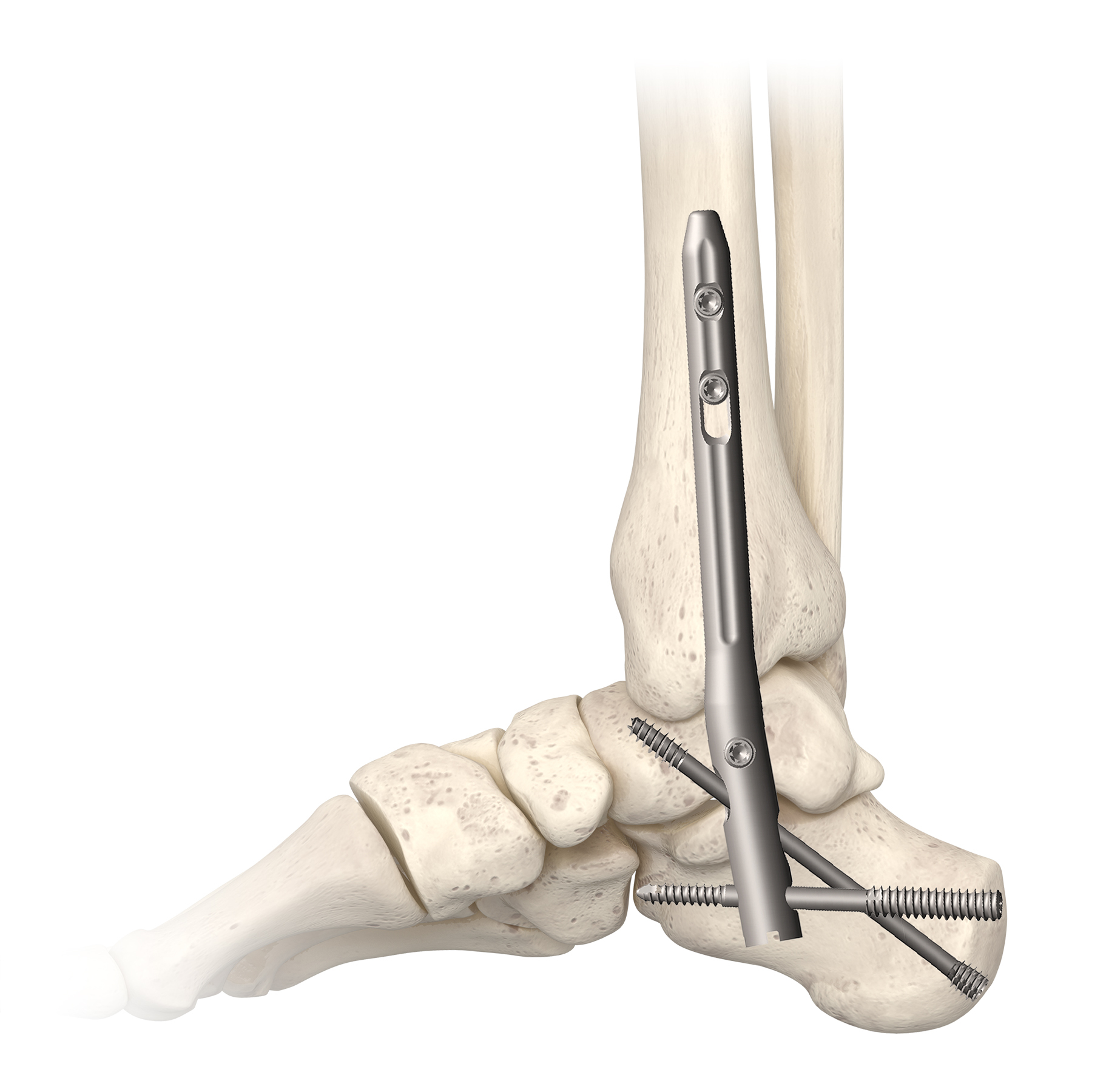 In2bones Announces The Global Launch Of The Triway Tibiotalocalcaneal Ttc Nail Arthrodesis System Business Wire