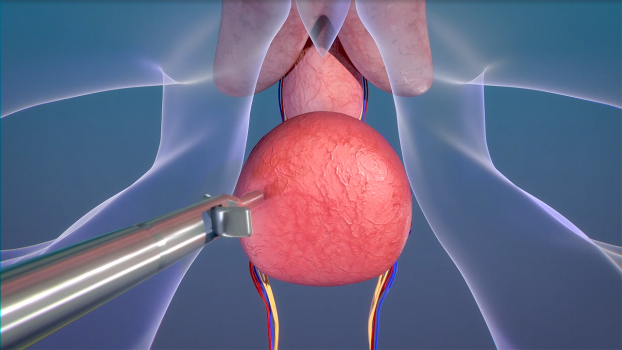 The Levita® Magnetic Surgical System, now FDA cleared for use in prostatectomy procedures