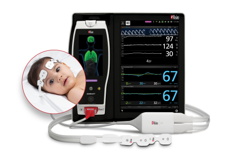 Masimo Root® with O3® Regional Oximetry (Photo: Business Wire)